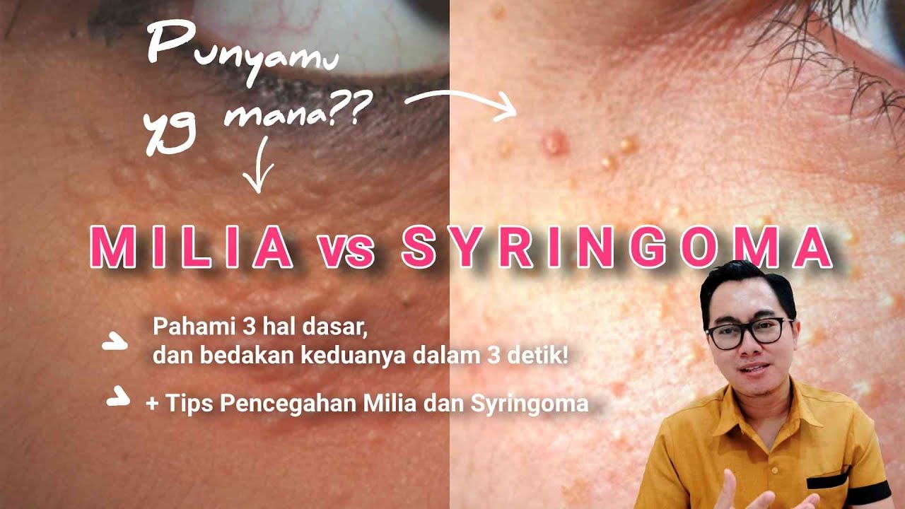 Bedakan Milia vs Syringoma Dalam 3 detik! | 3 Prinsip dasar Yang Wajib Diketahui, dr. Irfan Prasetya