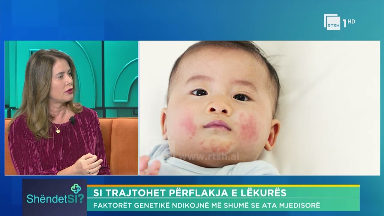 Ekzema - çfarë e shkakton dhe si trajtohet? Dr. Rozana Çela| “ShëndetSi” në RTSH