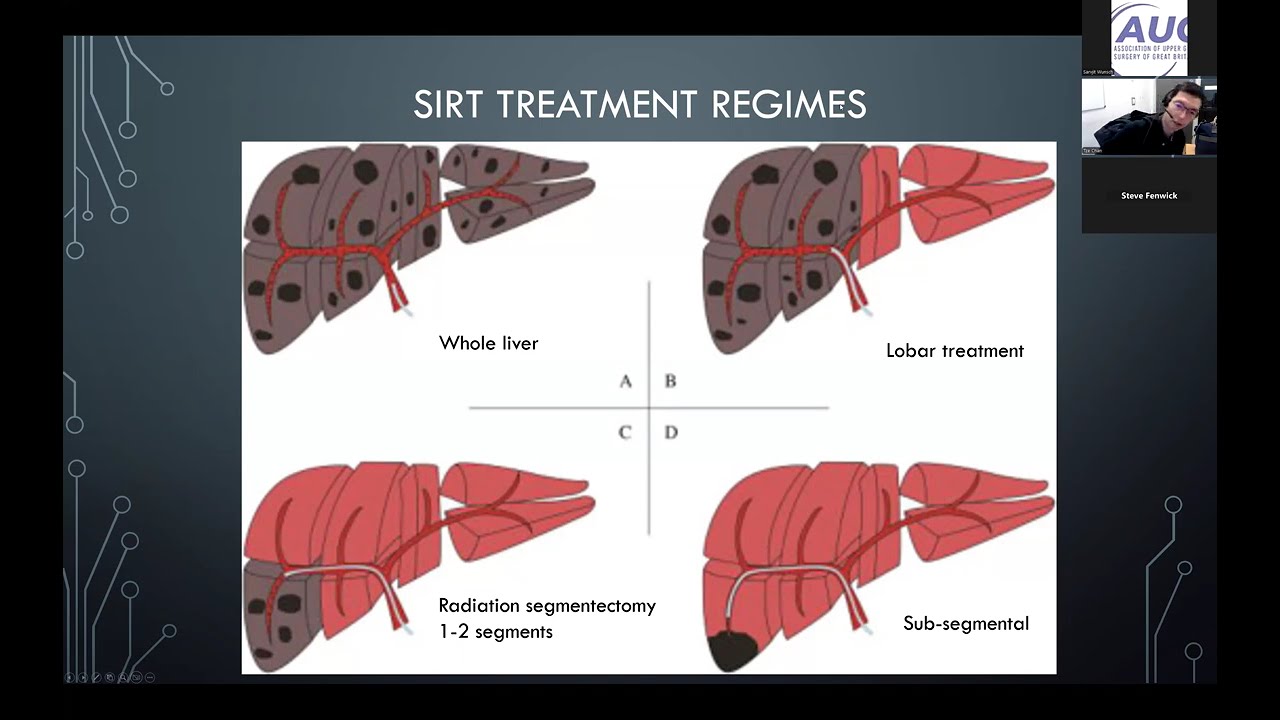 Advances in interventional oncology in liver surgery