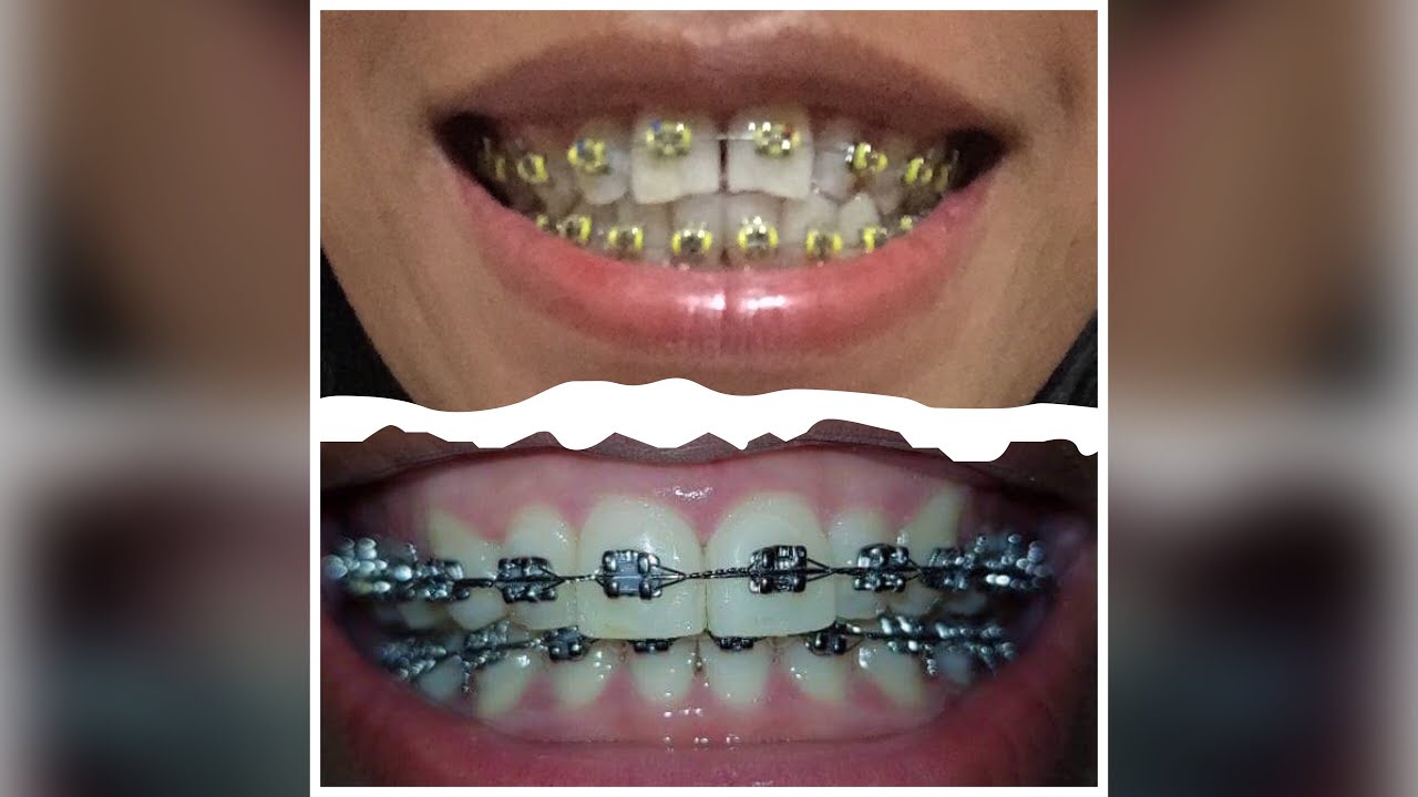 Braces Journey 😬(Cebu City )