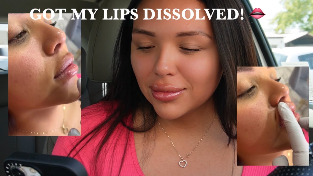 COME WITH ME TO GET MY LIPS DISSOLVED!