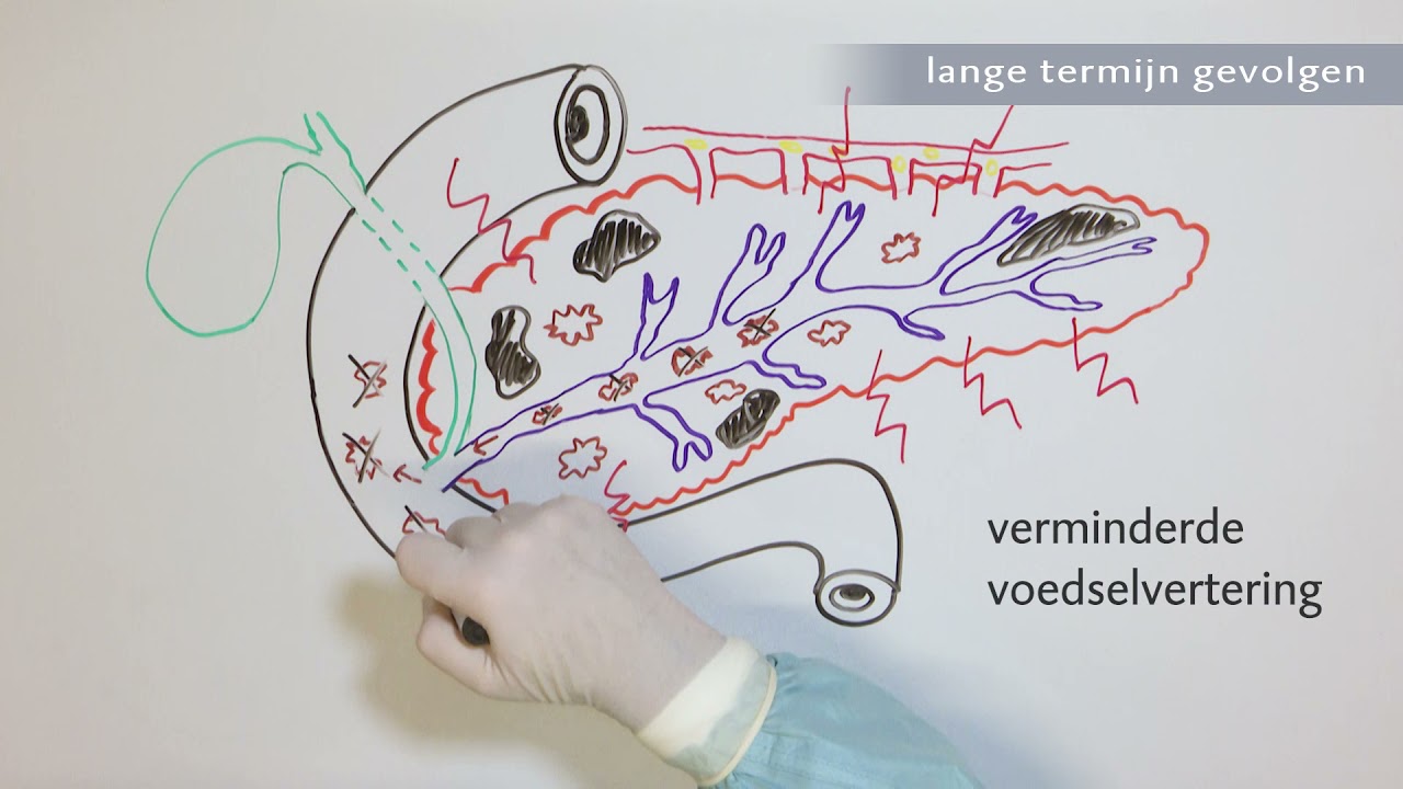 Voorlichtingsvideo - Acute Alvleesklierontsteking