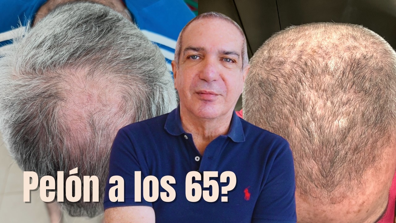 Cómo frené la caída del cabello a los 65 (y volvió a crecer)