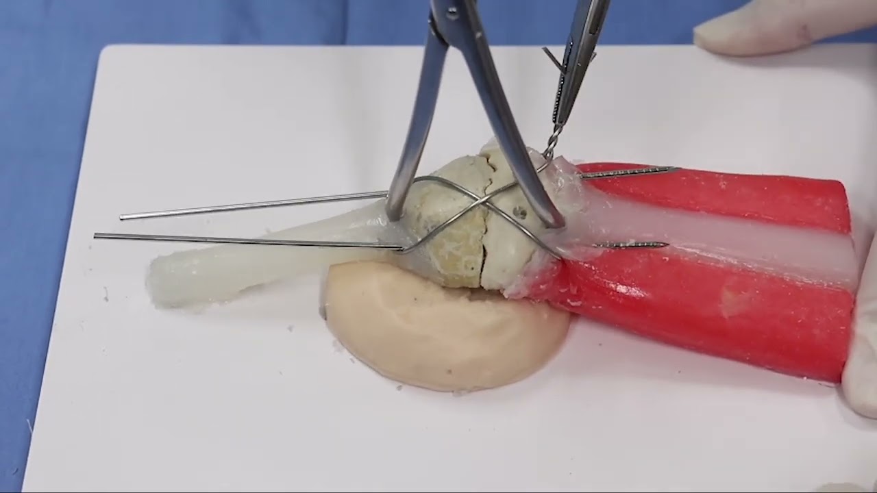 Patella fracture model for tension band wiring procedure.