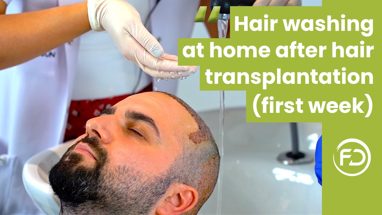 Hair Washing Procedure at Home After Hair Transplantation (First Week) - Tutorial