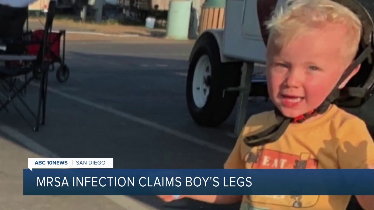 MRSA staph infection claims 3-year-old boy's legs during family vacation