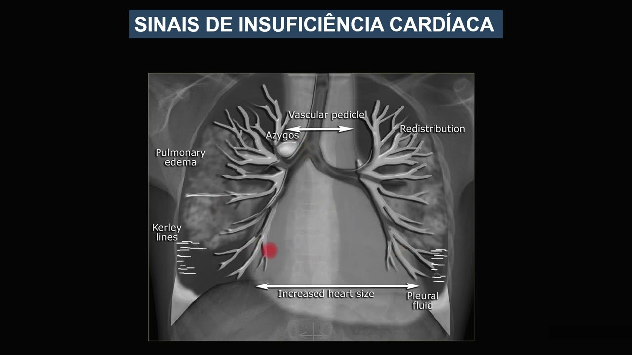 Indentificando os padrões da doença pulmonar no raio x do tórax - Aula 5