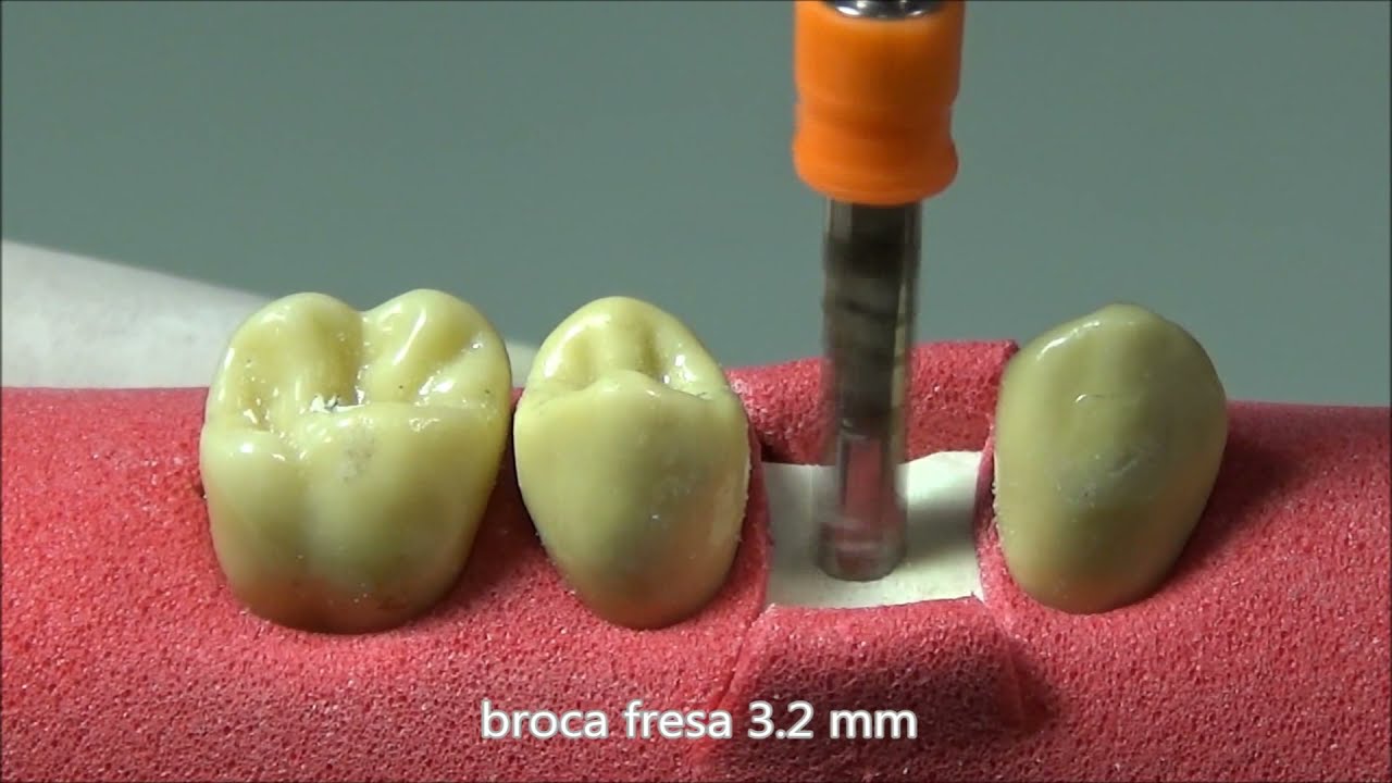 IMPLANTE DENTÁRIO - passo a passo