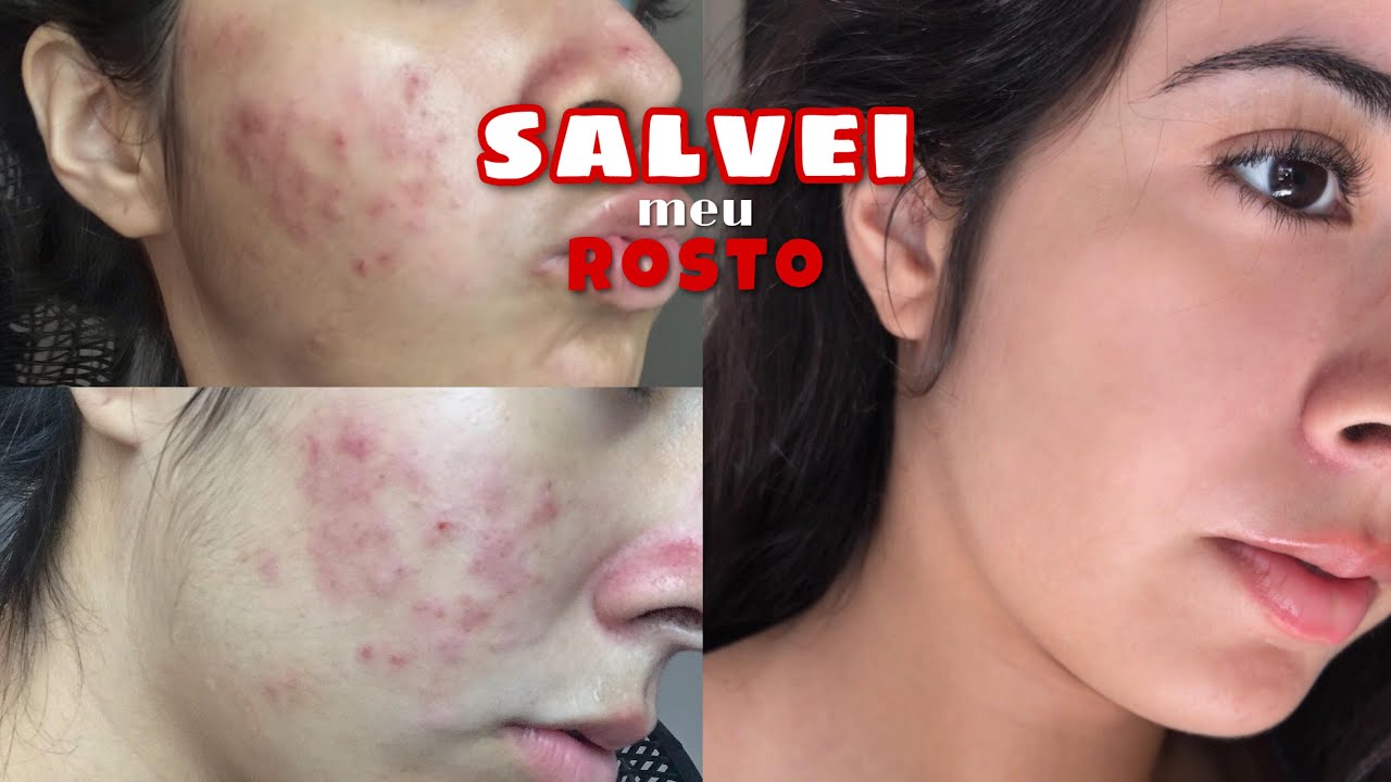 COMO ME LIVREI DAS ESPINHAS - esse método é MILAGROSO! 😱😍 (sem roacutan)