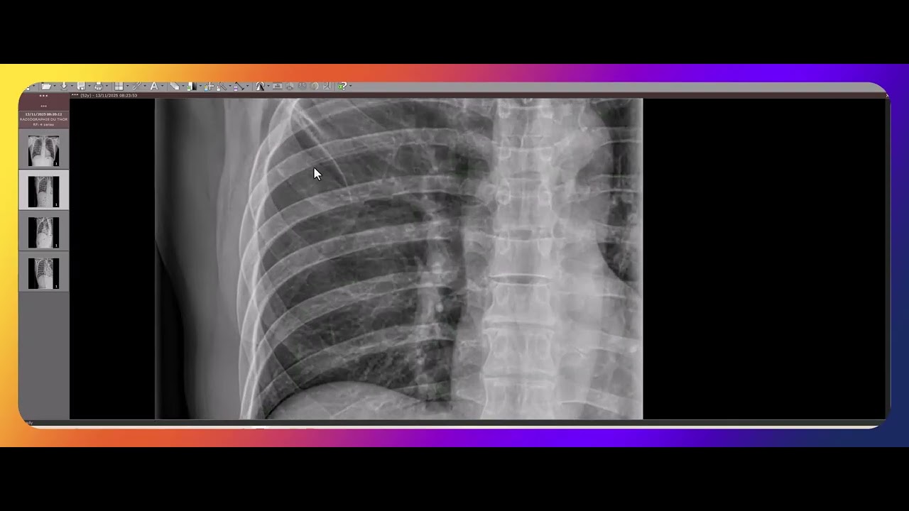 Nodule pulmonaire et gril costal : exemple en radiographie.