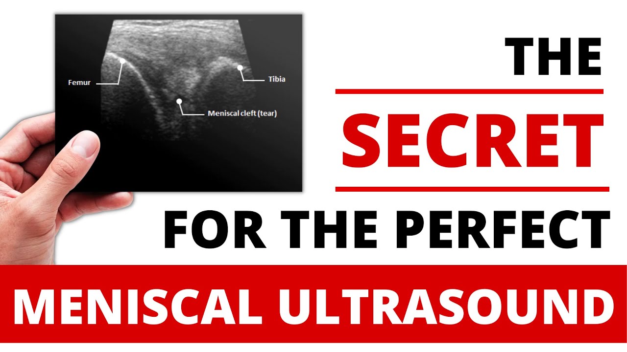 How To: Meniscal Ultrasound Technique (Tips and Tricks)