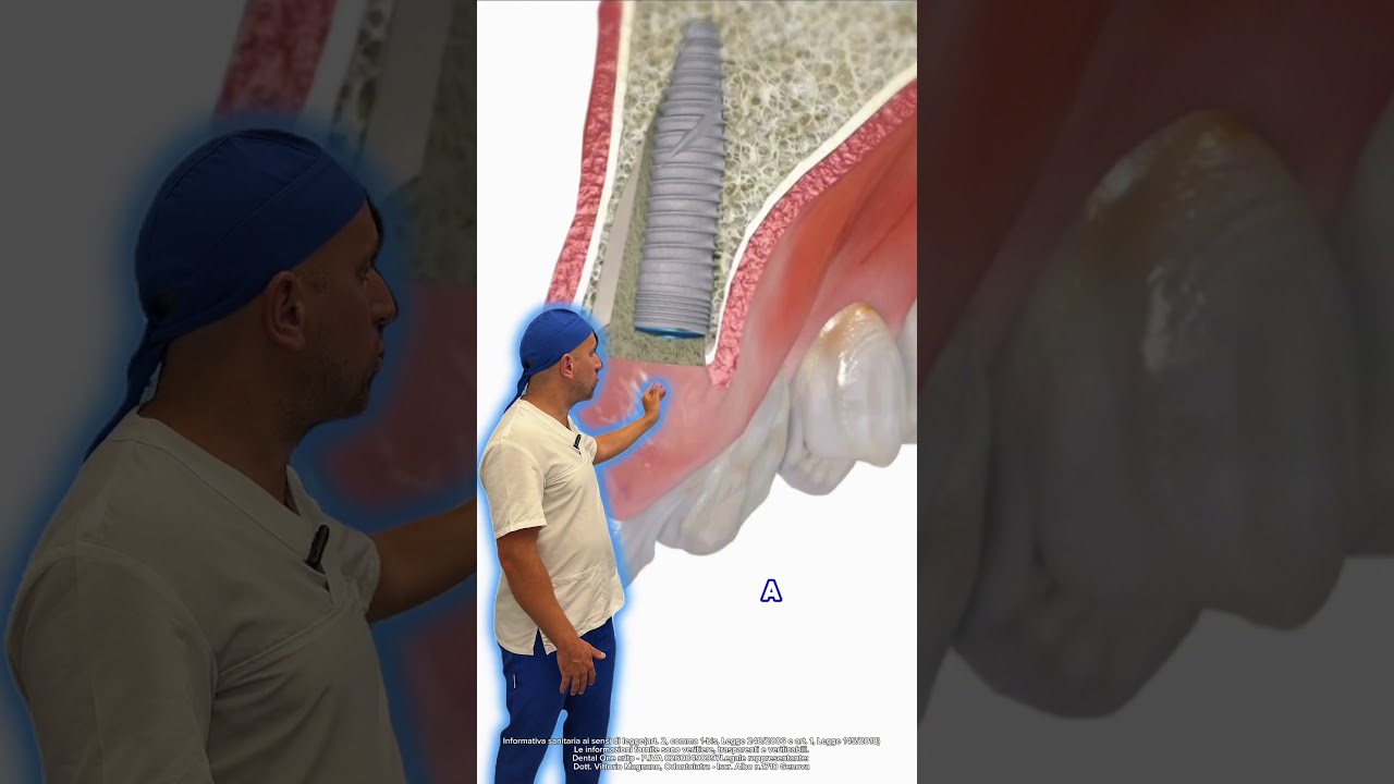 Come funziona un impianto dentale? #spigazione #impianto #dentista