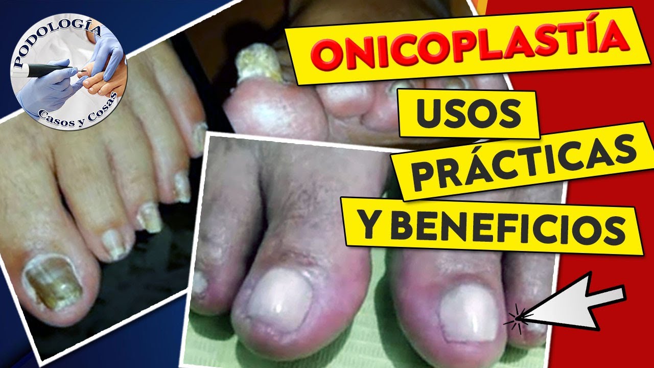 RECONSTRUCCIÓN UNGUEAL: USOS, PRACTICA Y BENEFICIOS | IQ Rakel Escalante | Podología Casos y Cosas