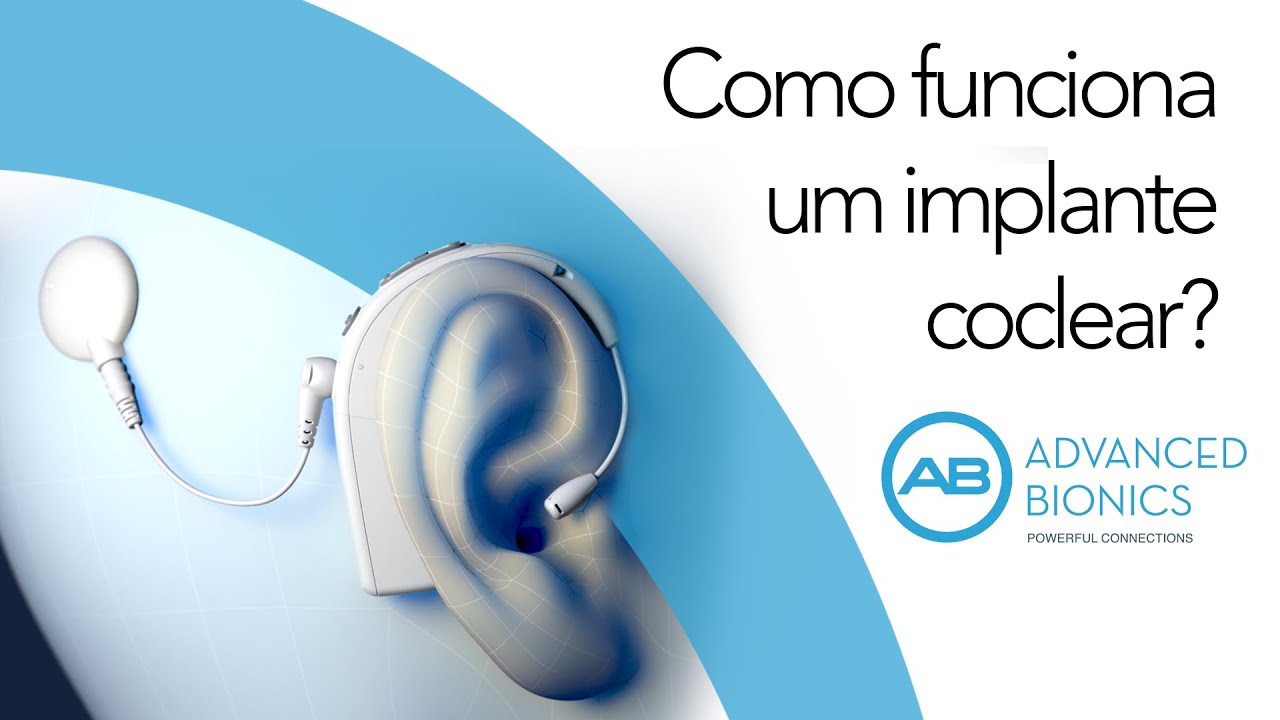 IMPLANTE COCLEAR - Como funciona um implante AB?