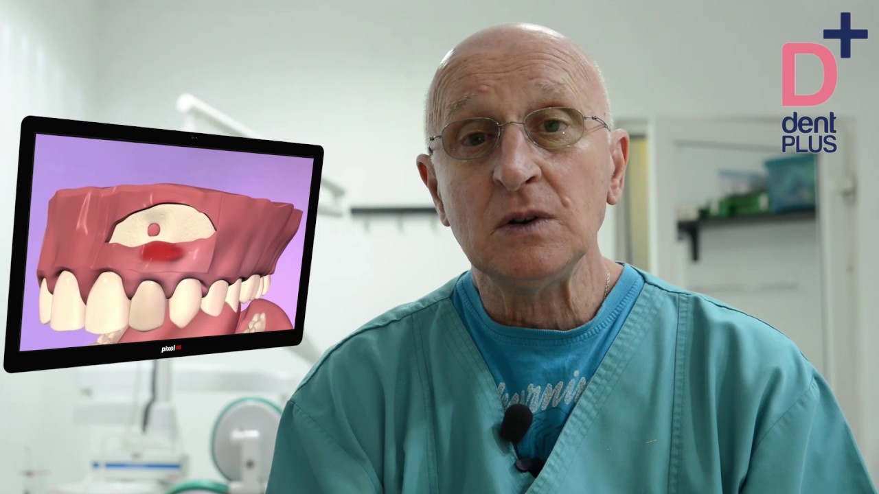 Chirurgie endoalveolara - Dentplus