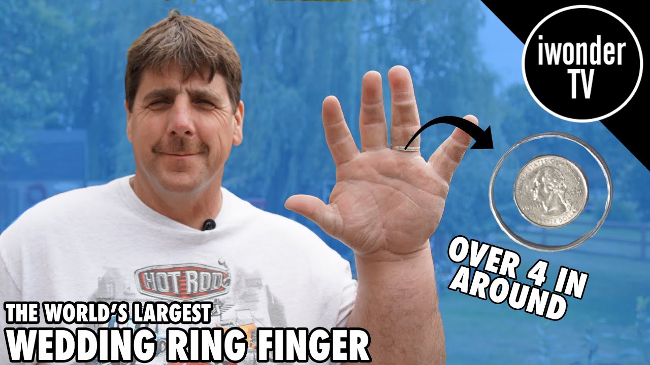 Jeff Dabe Has The World's Largest Wedding Ring Finger