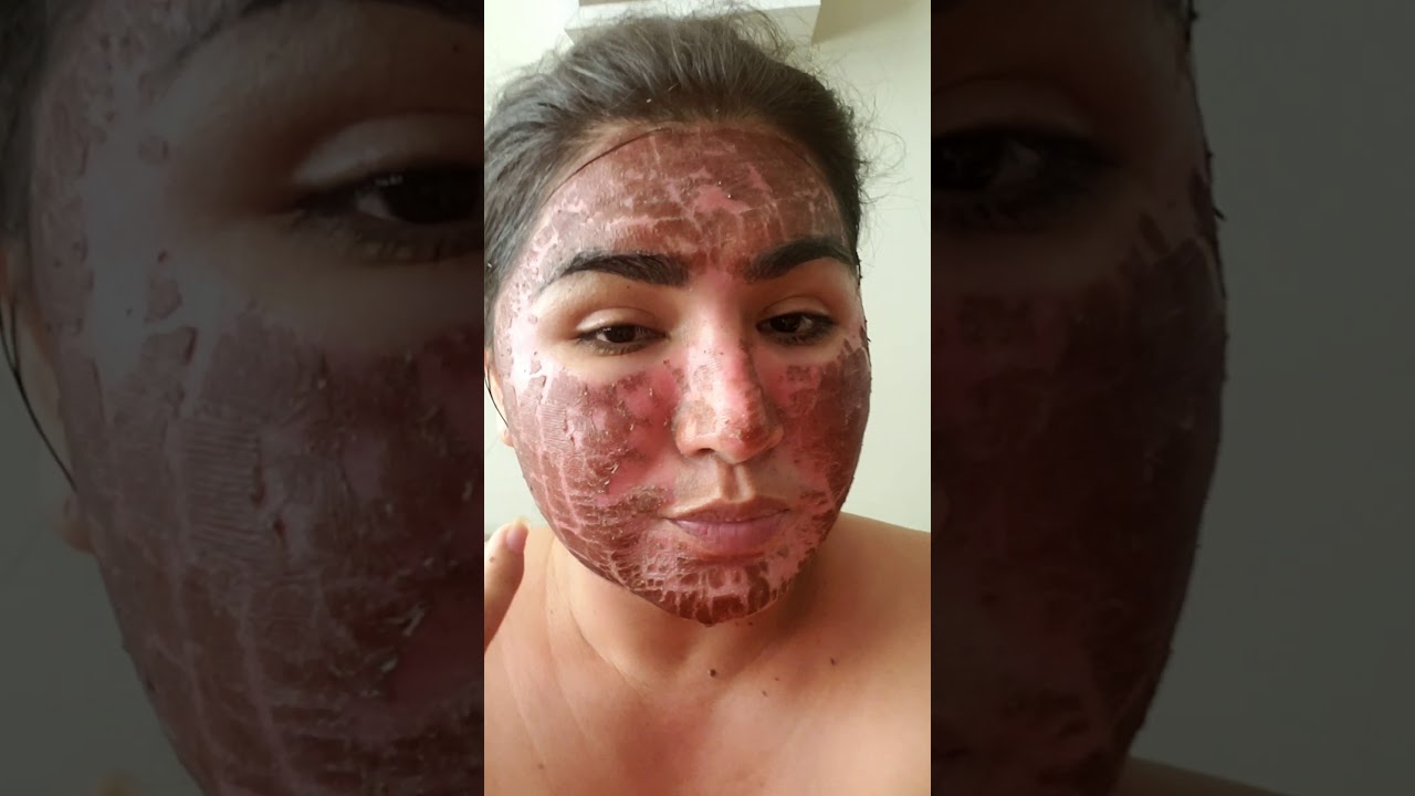 Me hice el laser CO2 fraccionado ,super intenso ,por mis secuelas de  acne