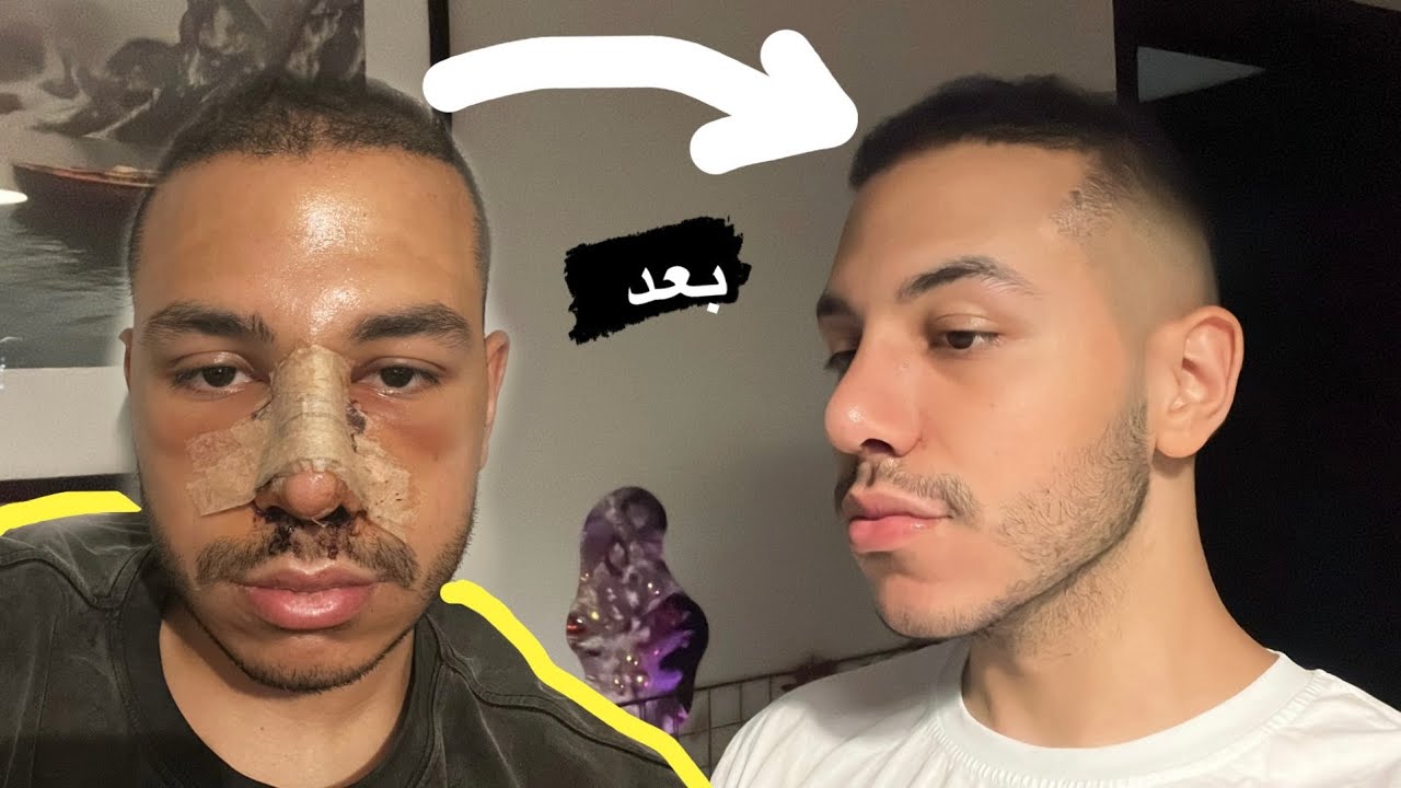 فلوج عملية تصغير انفي كامل مع النتيجه 😱