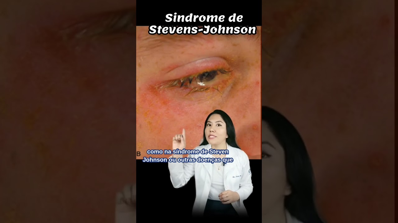 Indica&ccedil;&otilde;es da Lente escleral  #lentesdecontato #ceratocone #oftalmologia