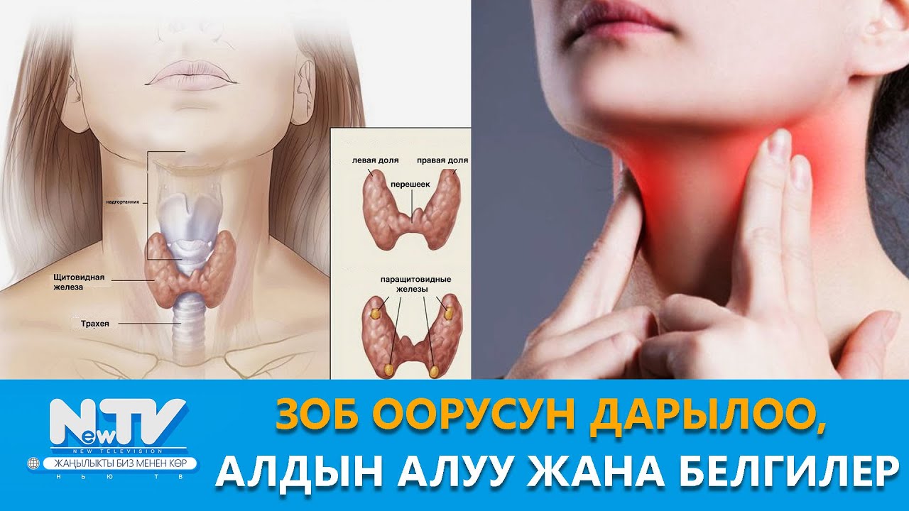 NewTV// Зоб оорусун дарылоо, алдын алуу жана белгилери. // Дабагер