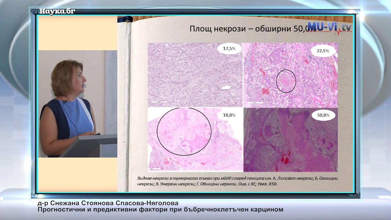 Прогностични и предиктивни фактори при бъбречноклетъчен карцином