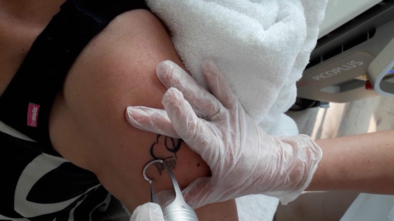 Tatoeage verwijderen | Nieuwste Picolaser!