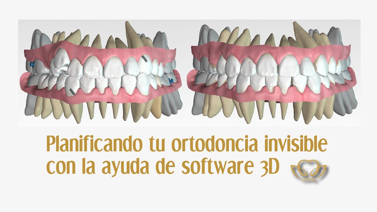 💻Planificación de ortodoncia mediante software 3D ▶ Ortodoncia Invisible antes y después 💥