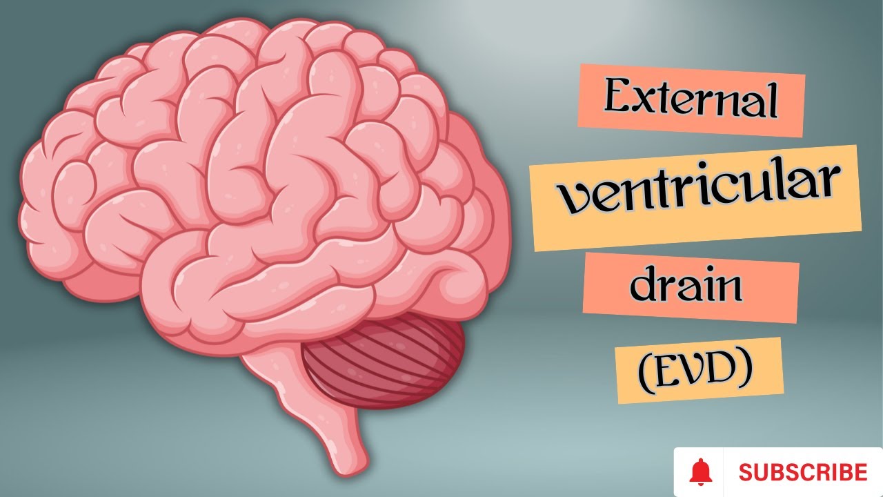 طريقة تركيب External ventricular drain (EVD) و استخداماتها والعناية التمريضية للمريض المتصل بها