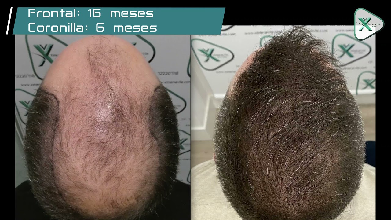 Trasplante Capilar FUE - Hair Trasplant - Dra. Ximena Vila - 6.446 Grafts