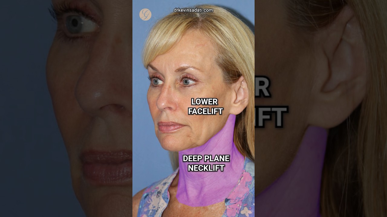 Gorgeous Mini Facelift Results #cosmeticsurgery #antiaging #goviral #beforeandafter