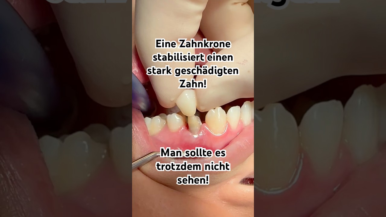 ZAHNKRONE - Ein neuer Zahn wird geboren! #zahnersatz #zahnkrone #sch&ouml;nez&auml;hne