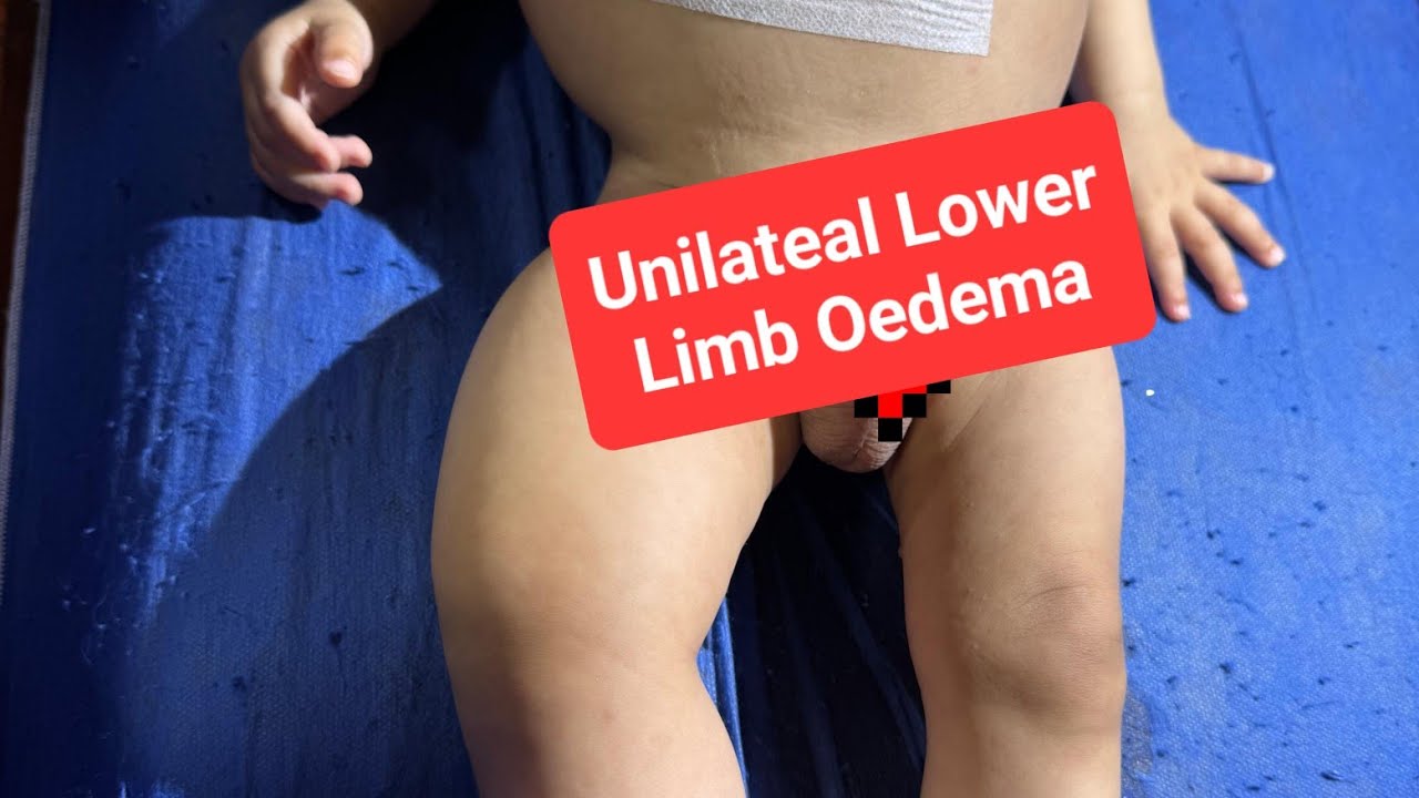 Case No 100 :.Infantile oedema