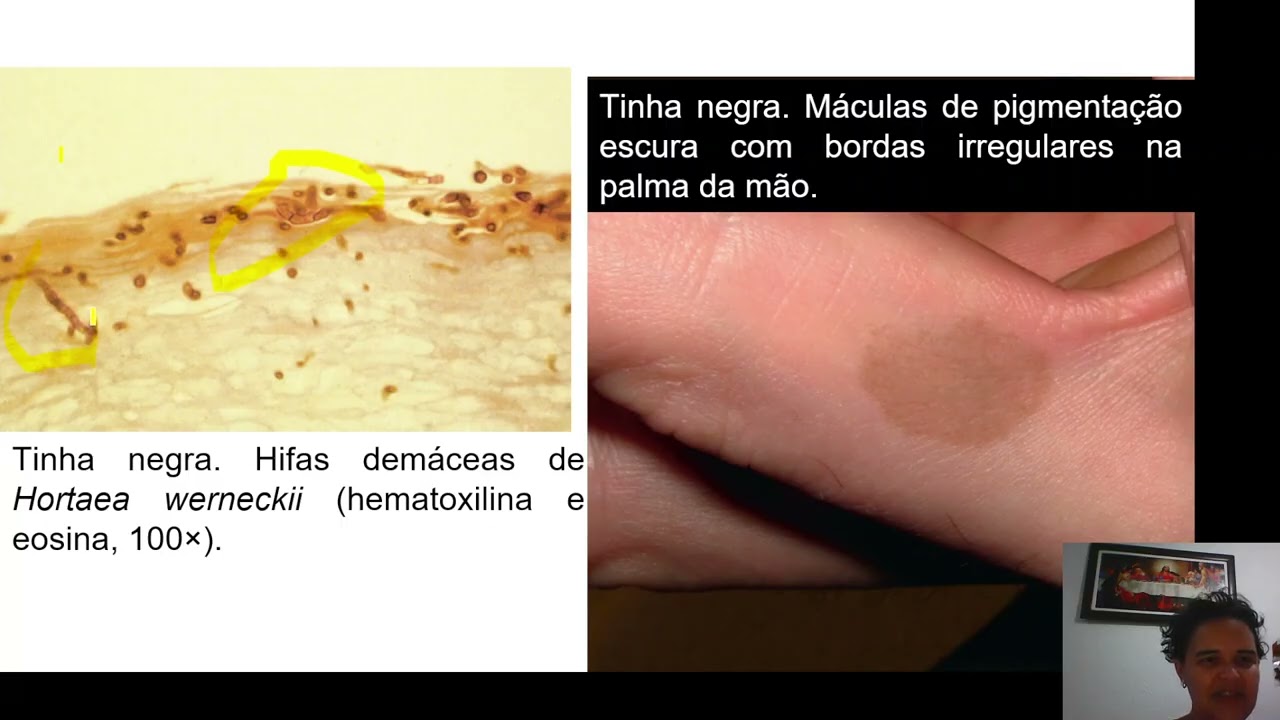 Aula 06 Micoses Superficiais Cutaneas e Subcutaneas parte 1