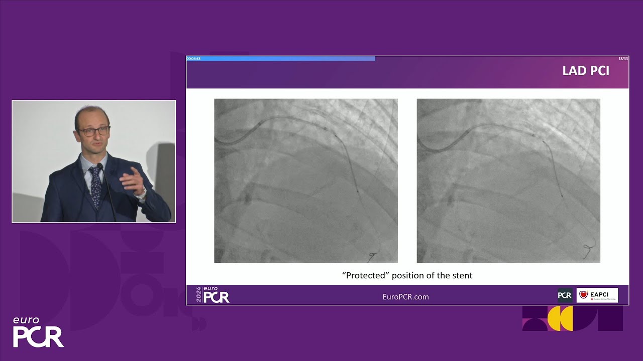Cracking open the discussion on the clinical experience with intravascular lithotripsy in ACS