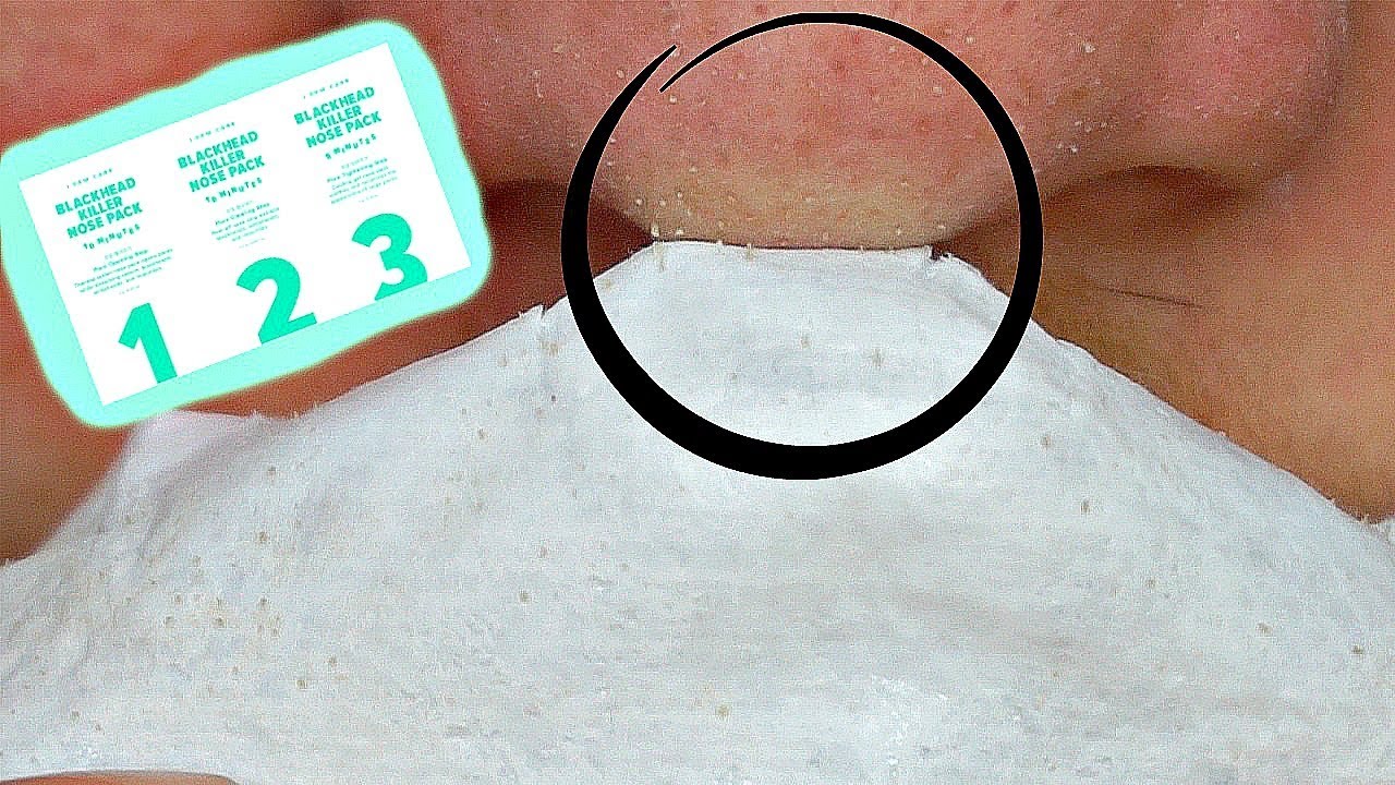 BLACKHEAD REMOVAL!!