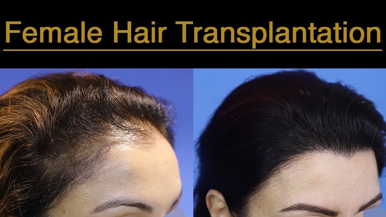 Natural looking hairline restoration in Female Hair Transplantation - 1500 grafts, 12-months