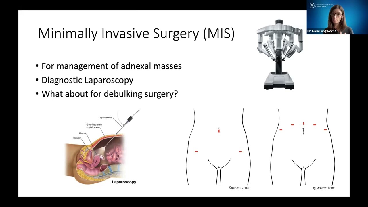 Beyond the Basics: Ovarian Cancer Surgery
