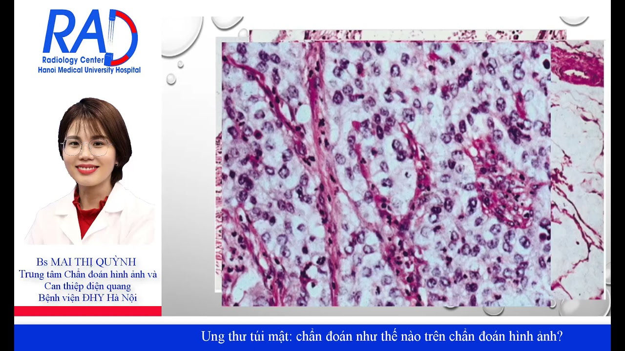 Ung thư túi mật: Chẩn đoán như thế nào trên chẩn đoán hình ảnh?