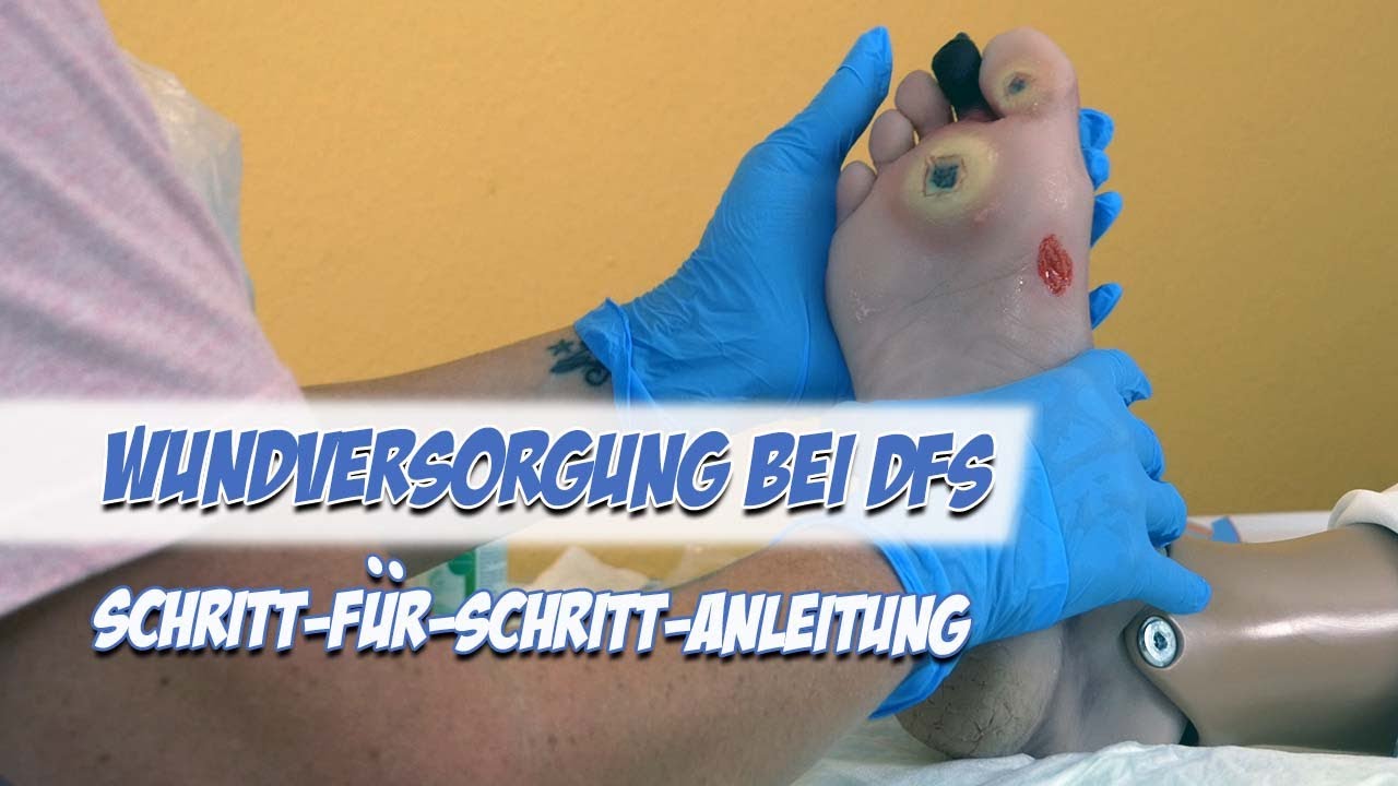Diabetisches Fußsyndrom: Wundversorgung | Schritt-für-Schritt-Anleitung | Pflege Kanal
