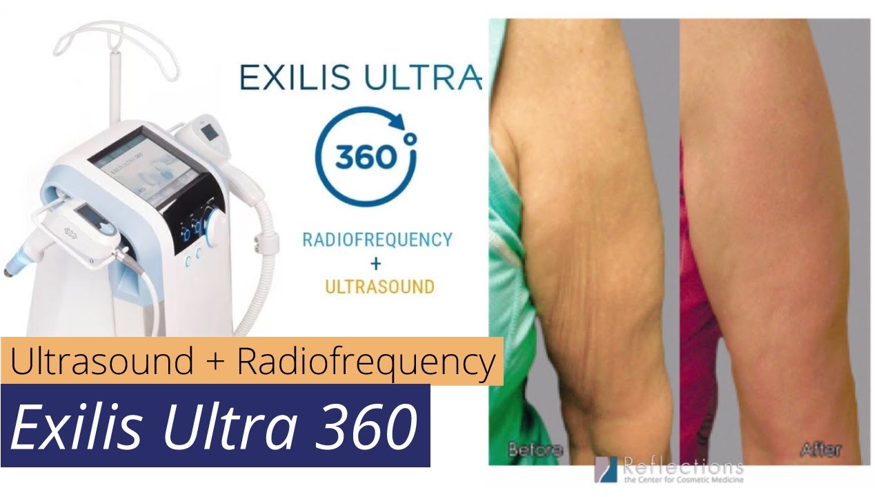 NEW! Exilis Ultra 360 [ #USRF Skin Tightening ]