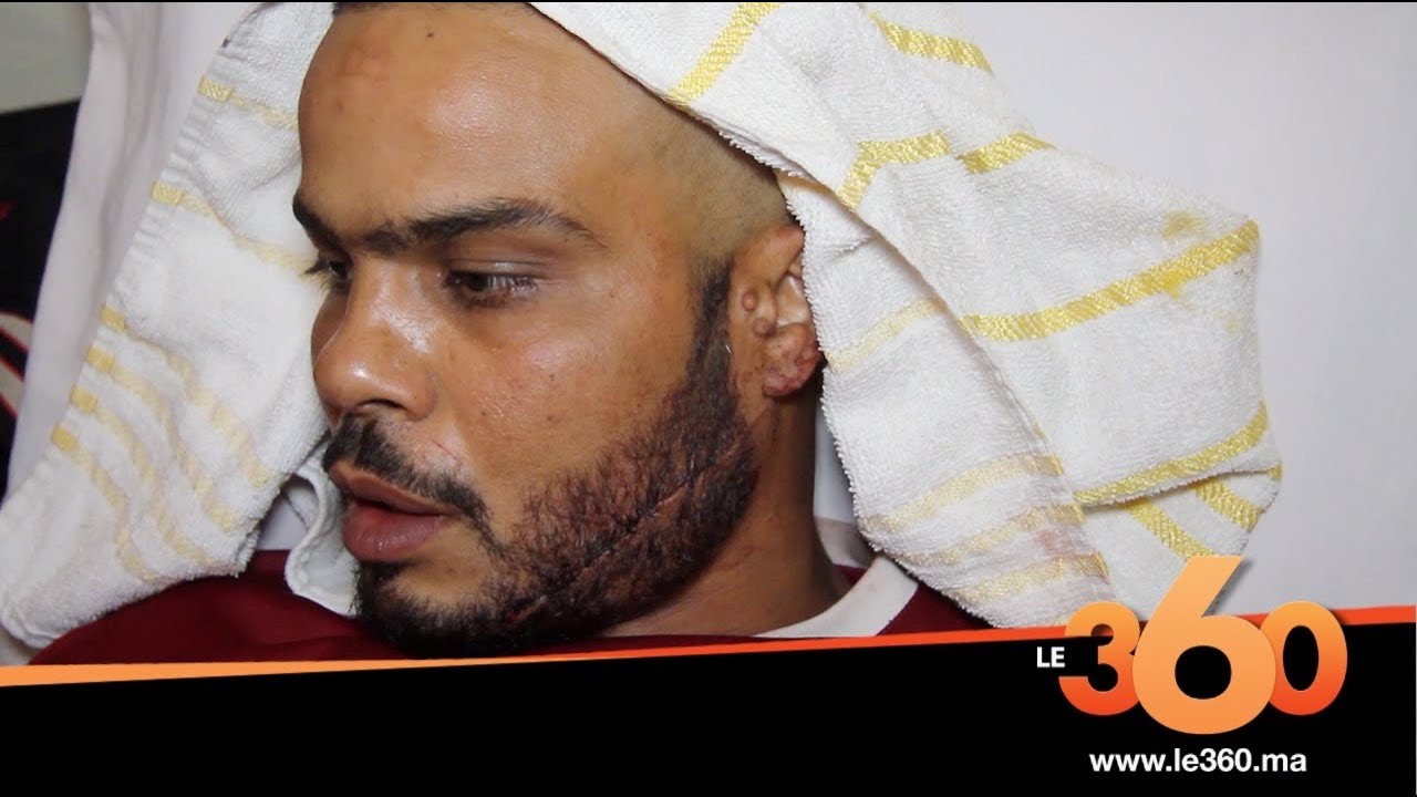 Le360.ma • ضحية شغب كروي بمدينة أسفي يروي تفاصيل الاعتداء عليه