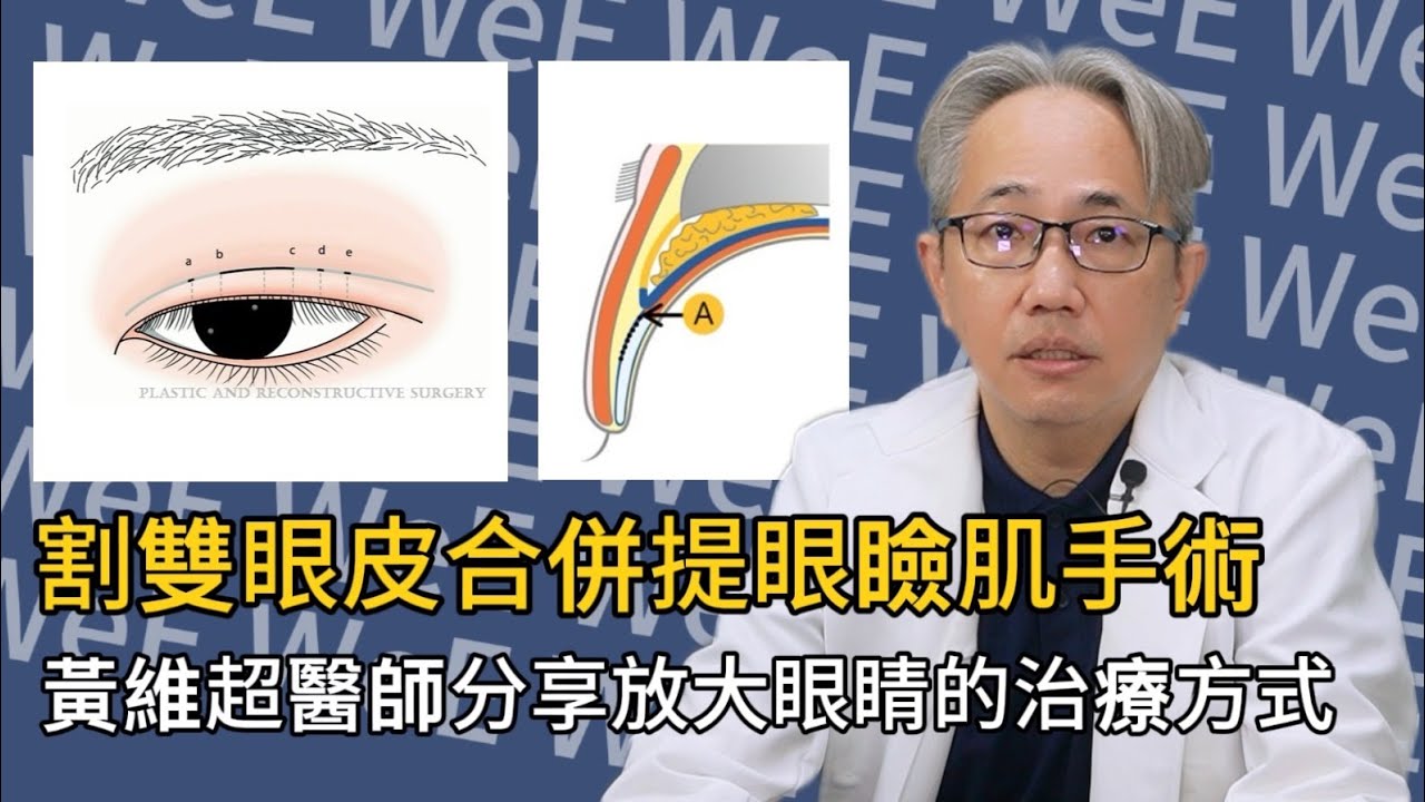 雙眼皮手術第3集｜割雙眼皮合併體眼瞼肌手術｜黃維超醫師分享放大眼睛的治療方式｜維美醫學整形外科診所