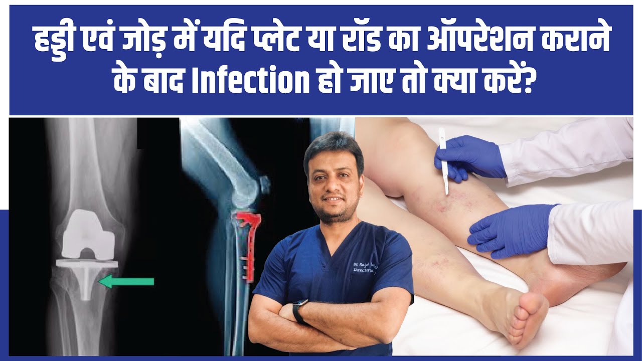 हड्डी में प्लेट या रॉड लगाने के बाद इंफेक्शन? सही इलाज और बचाव के तरीके | Dr. Rajat Malot