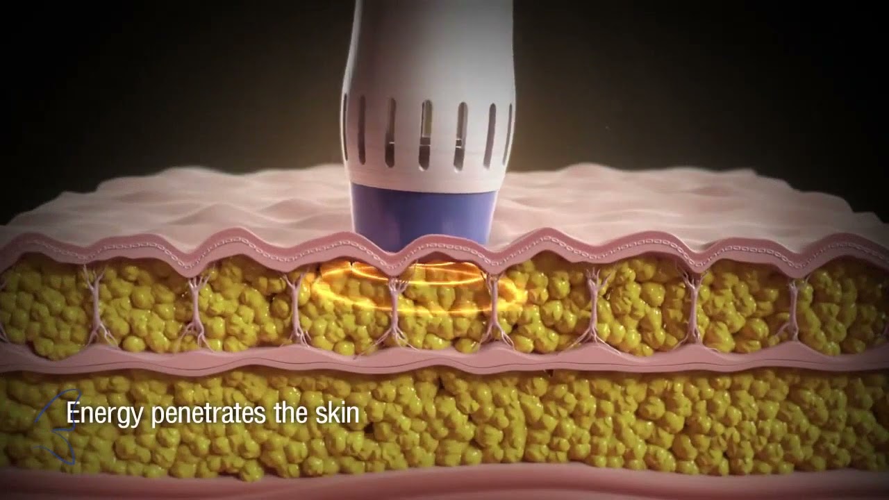 Reduce Cellulite and Enhance Body Contouring Results with ZWave