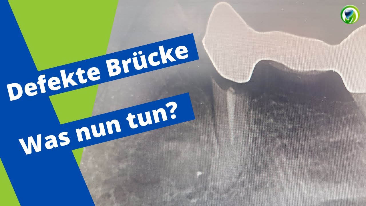 Defekte Brücke - Was kann ich nun tun? - ein Patientenfall - Varianten für neuen Zahnersatz