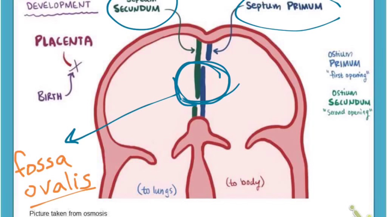 Left to right shunt (atrial septal defect)