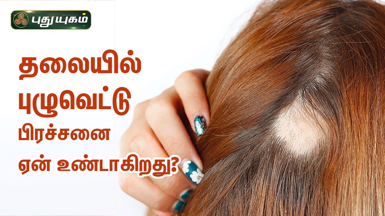 தலையில் புழுவெட்டு பிரச்சனை ஏன் உண்டாகிறது? வராமல் தடுப்பது எப்படி? Dr.Jayaroopa | Iniyavai Indru