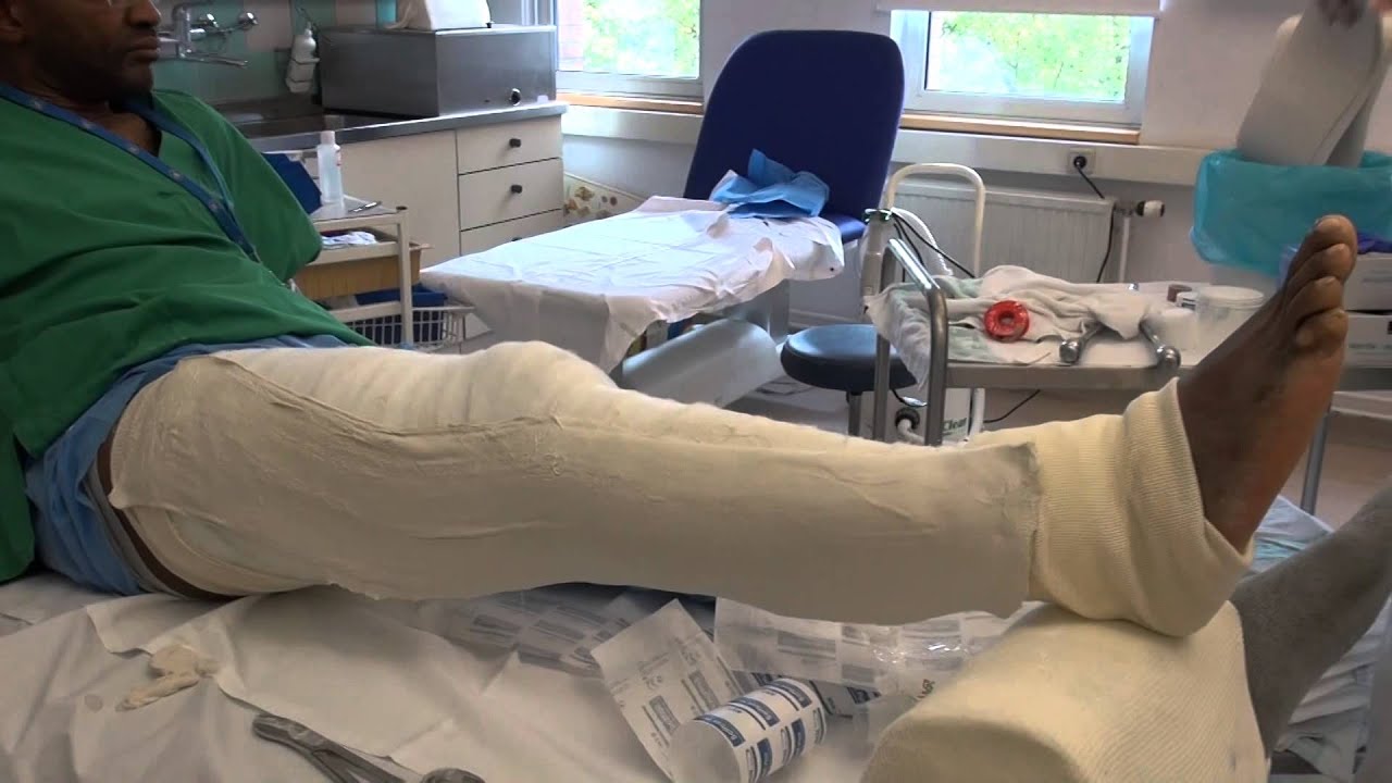 Attelle plâtrée pour une fracture de la rotule (cruro-malléolaire)