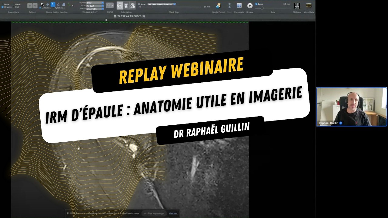 IRM de l'épaule : anatomie utile en imagerie