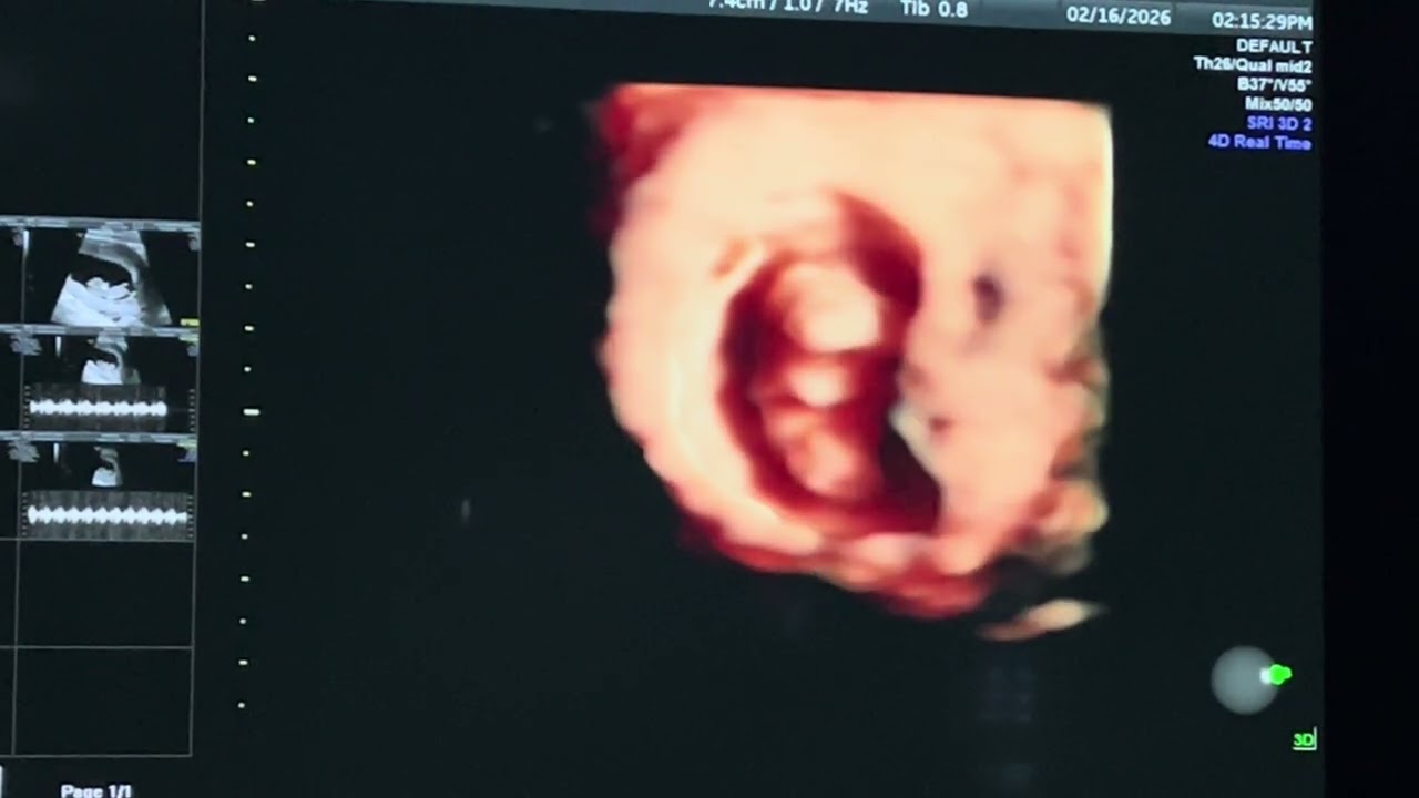 Grandbaby 🩷 2/16/26 10 weeks